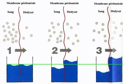 Association des mécanismes de diffusion et de convecton par osmose dans la dialyse péritonéale
